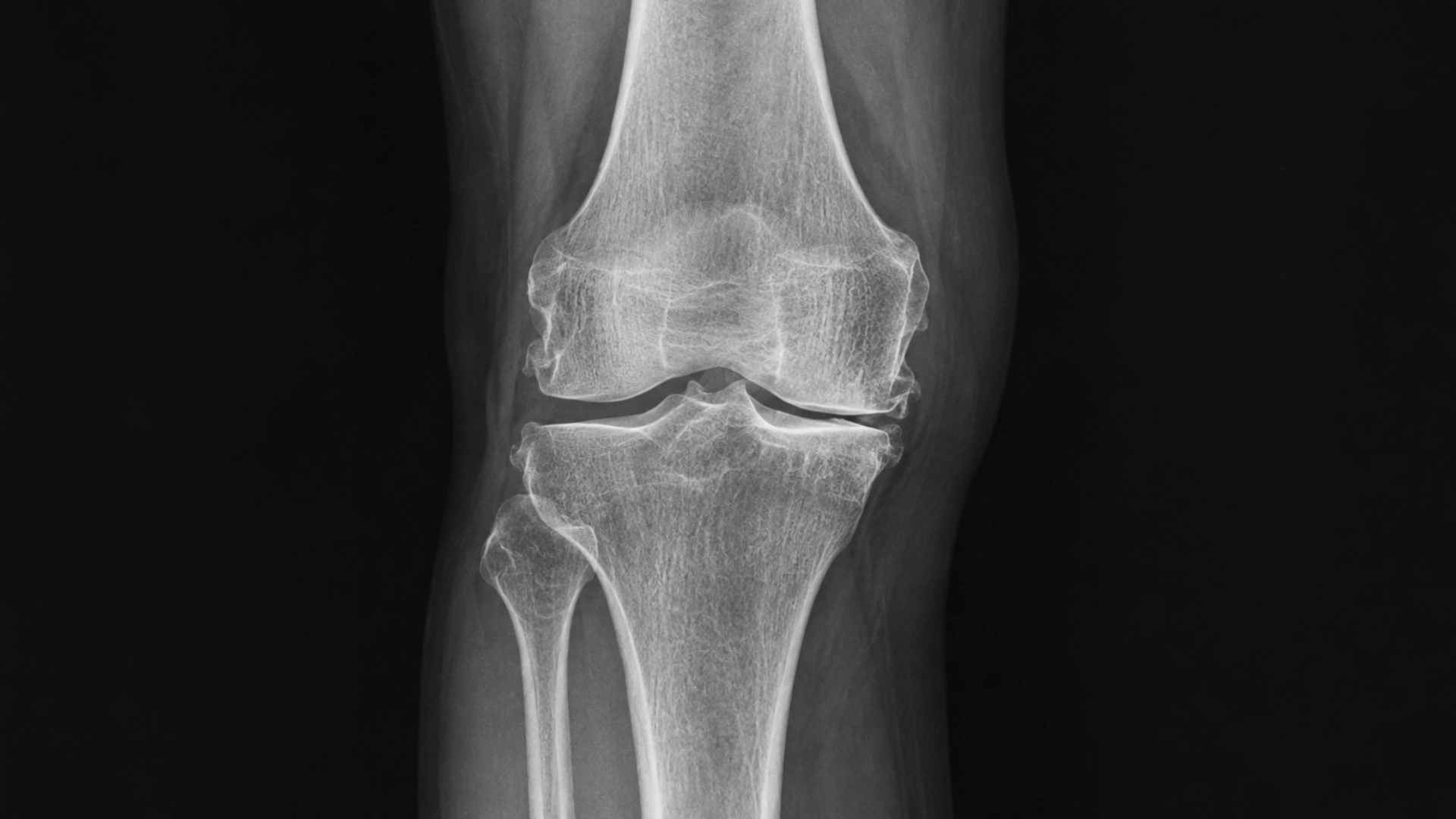 Knee osteoarthritis grade 3 imaging and clinical assessment